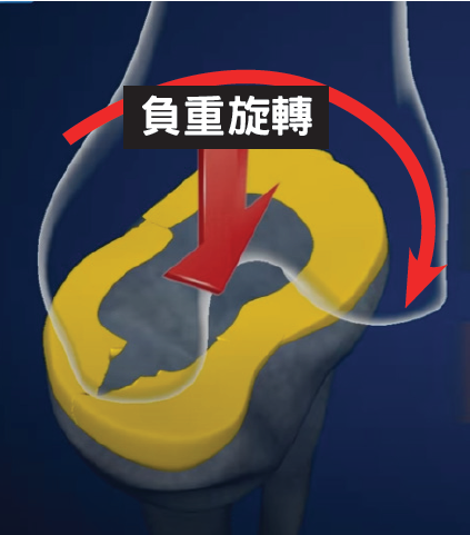 半月板